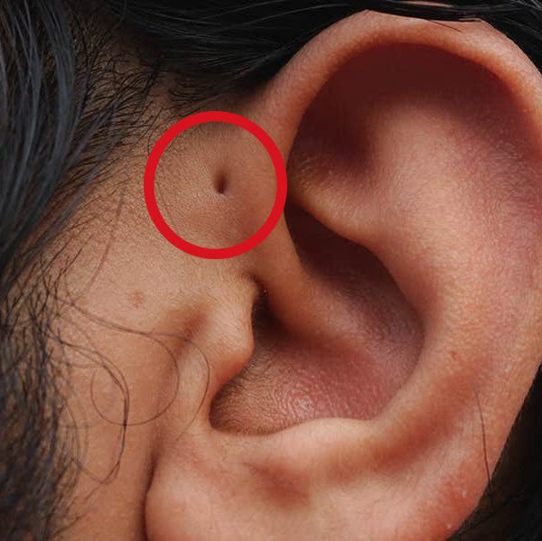 Hole in the Ear Spiritual Meaning – Preauricular Sinus in Bible